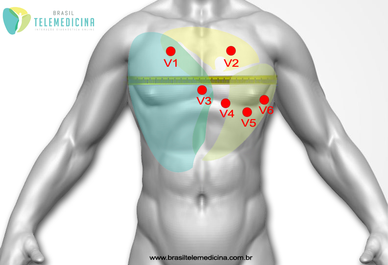 ECG-Eletrodos-BrasilTelemedicina
